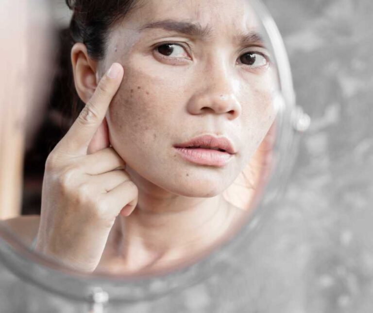 How To Get Rid Of Melasma For Asian Skin?